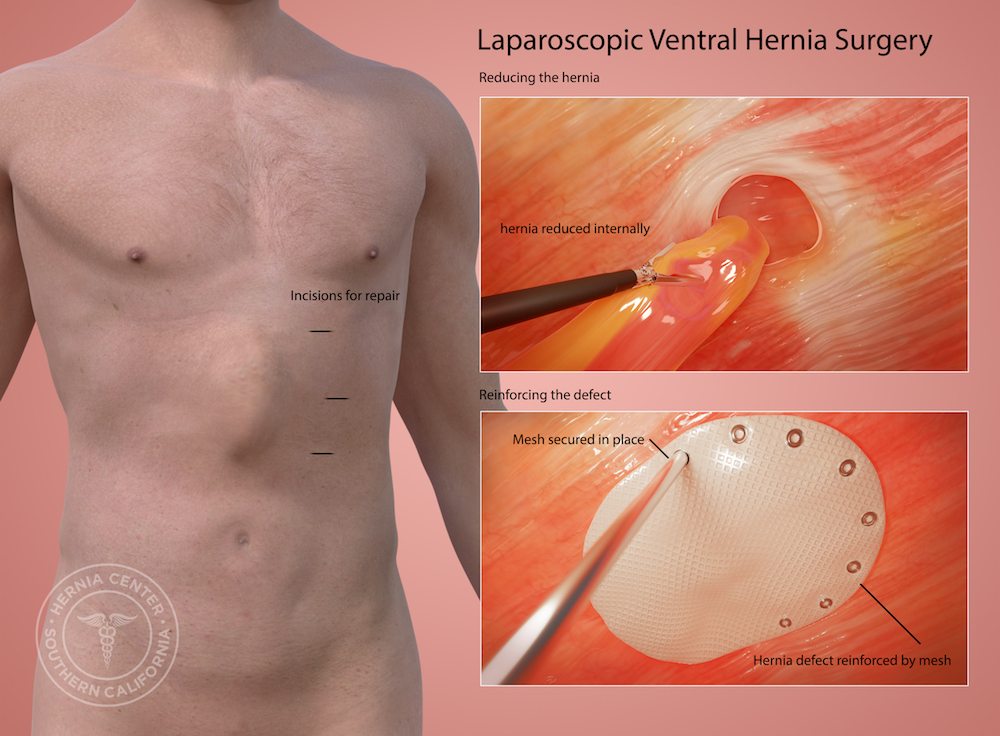 Laparoscopic Ventral Hernia 