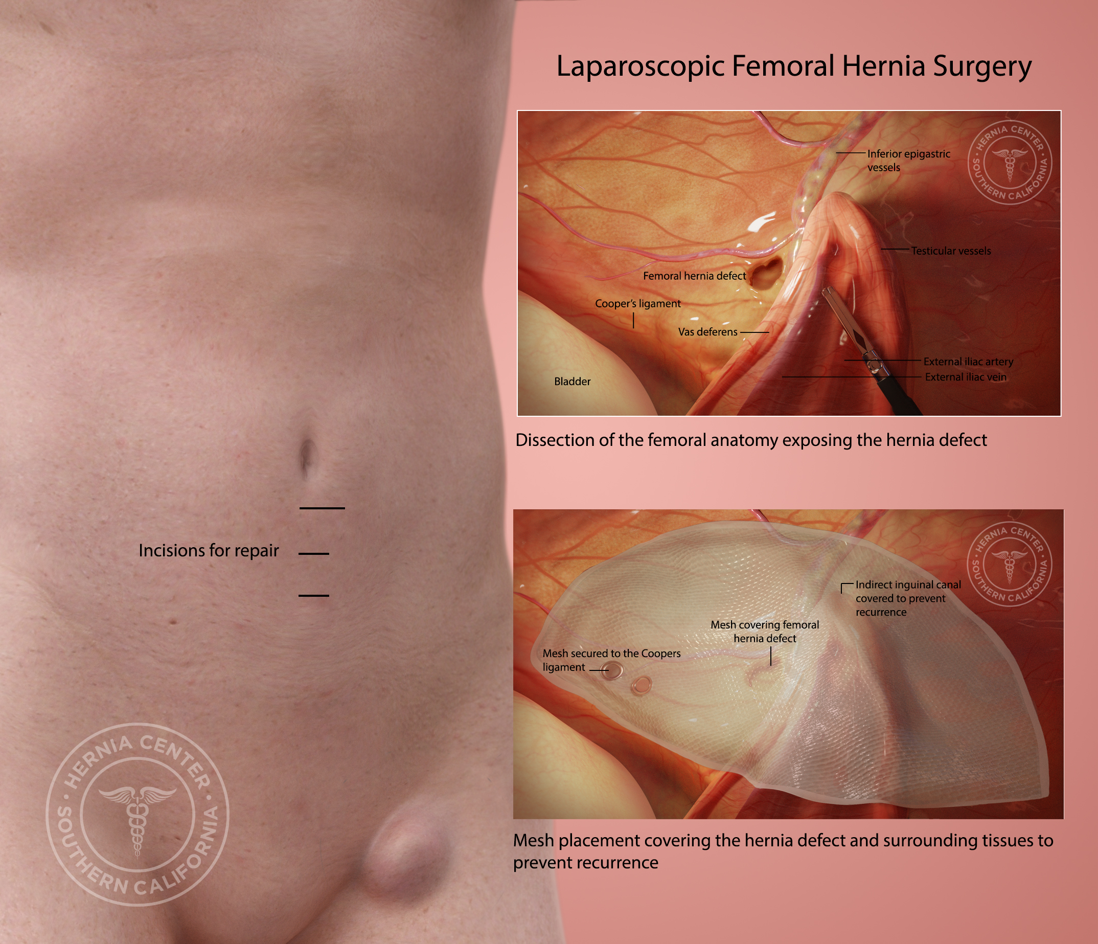 https://herniaonline.com/wp-content/uploads/Laparoscopic-femoral-hernia-surgery-2.jpg