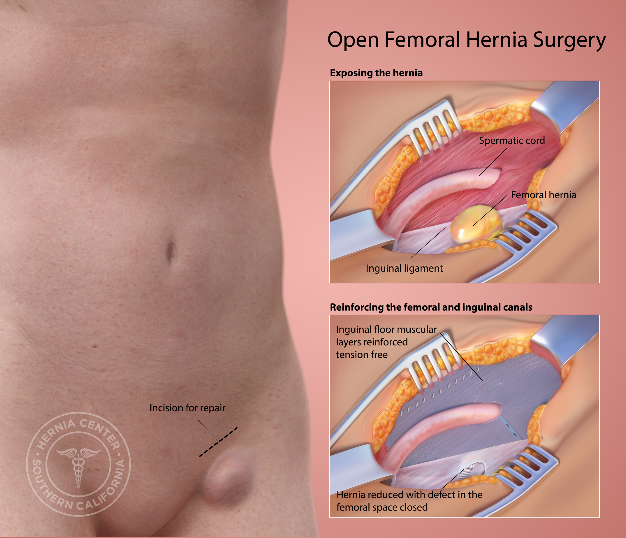 Femoral Hernia Repair in the Pasadena and Orange County CA Area