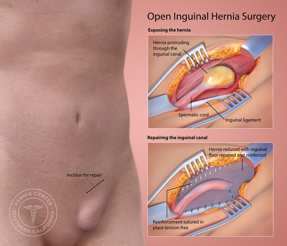 Open Surgery for Femoral Hernias: a Single Approach with Double Window for  All
