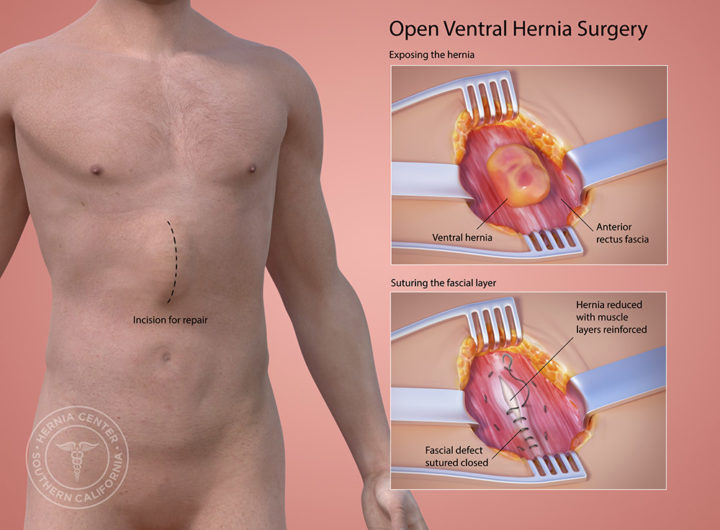Ventral Hernia Repair Before And After Pictures
