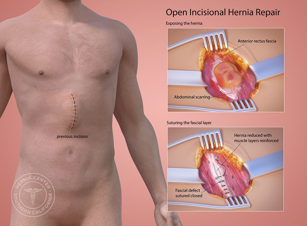 Incisional Hernia Surgery'