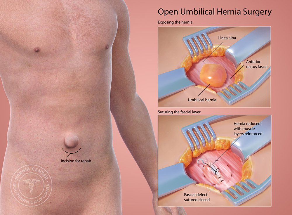 Open umbilical hernia surgery